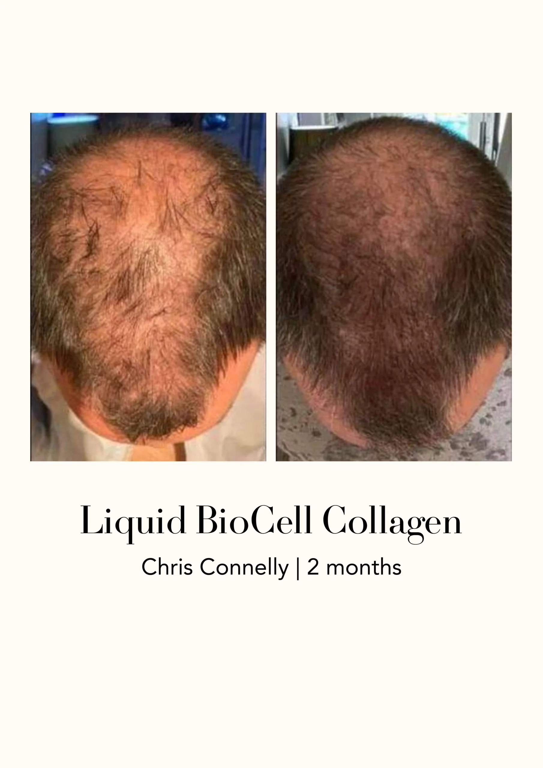 Modere Liquid BioCell Collagen Before After Hair - Shaklee NZ Modere Liquid BioCell NZ — collagen supplement New Zealand